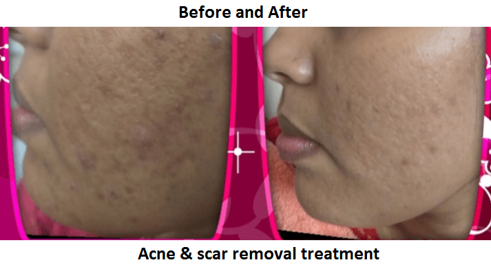 acne and scar removal acne and scar removal
