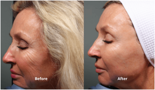 before-after HIFU before after Results