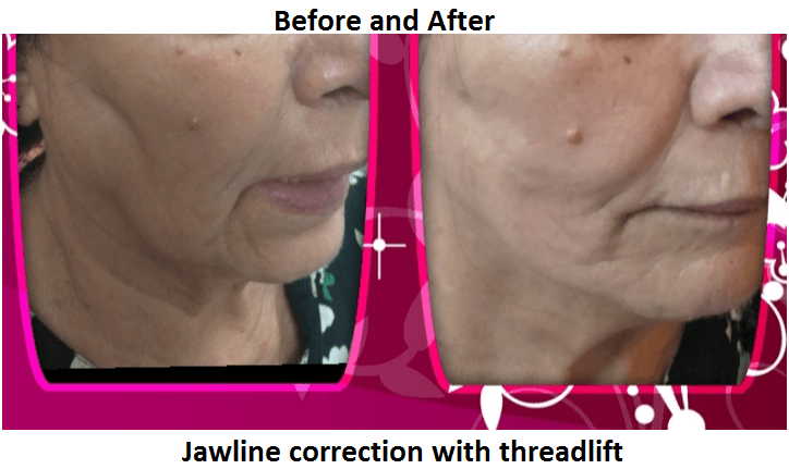 jawline-correction-with-threadlift jawline-correction-with-threadlift