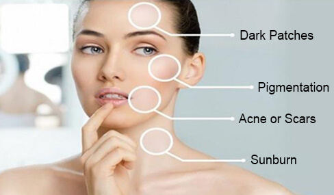 Right candidate for Skin Whitening Treatment Right candidate for Skin Whitening Treatment