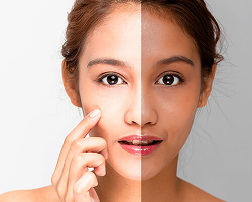 Skin Whitening Treatment in Hyderabad