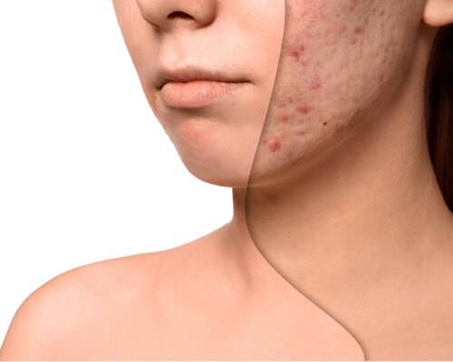 Acne Scar Treatment in Hyderabad